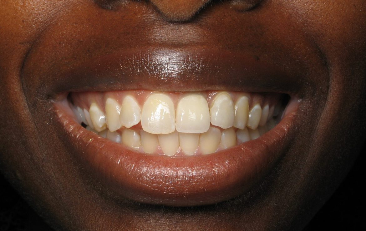 Burbank Implant Dentist on Extraction Defects…Relation to Dental Implants and Bone Grafts