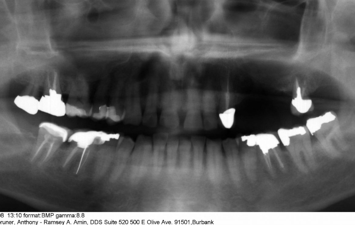 Tony H. – Dental Implants and SInus Lift – The Patient Perspective