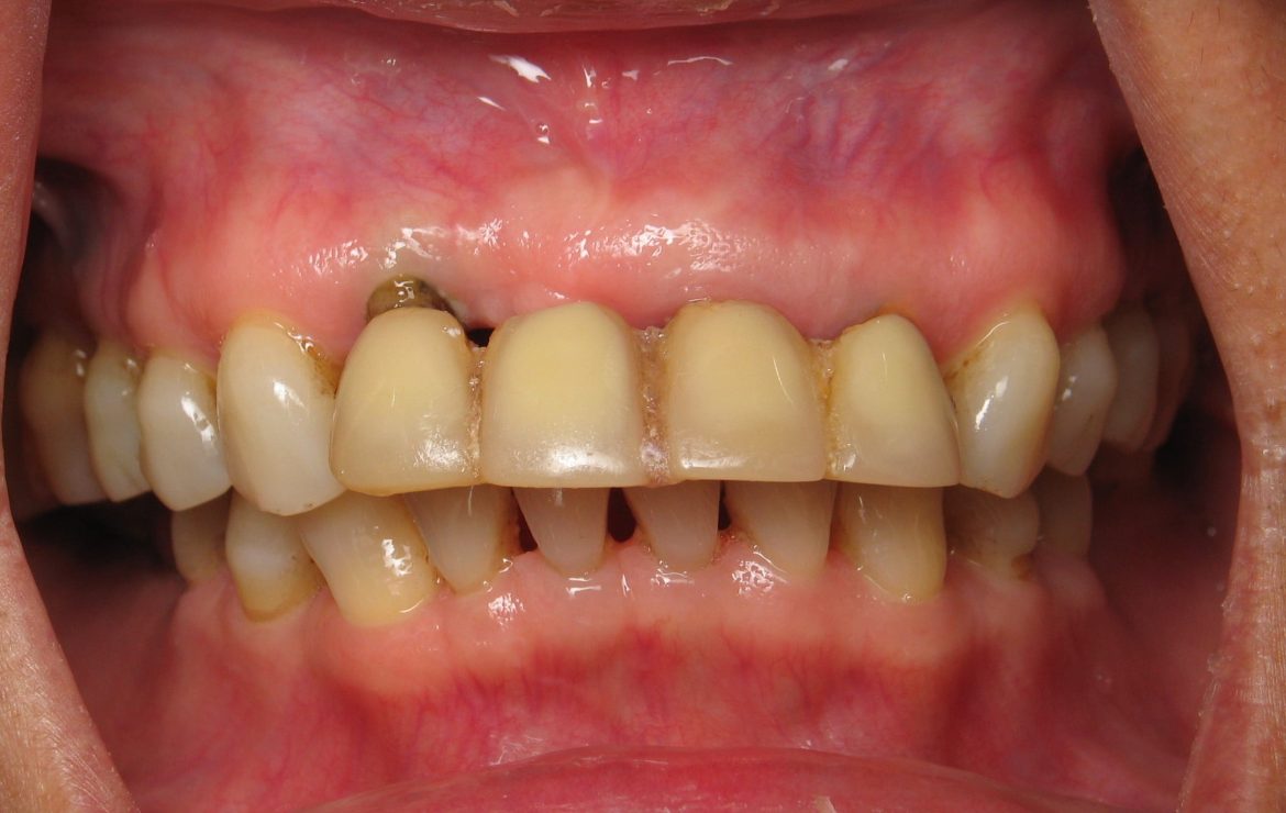 The Ovate Pontic – Ramsey Amin DDS of Burbank Explains This Dental Implant Bridge Detail