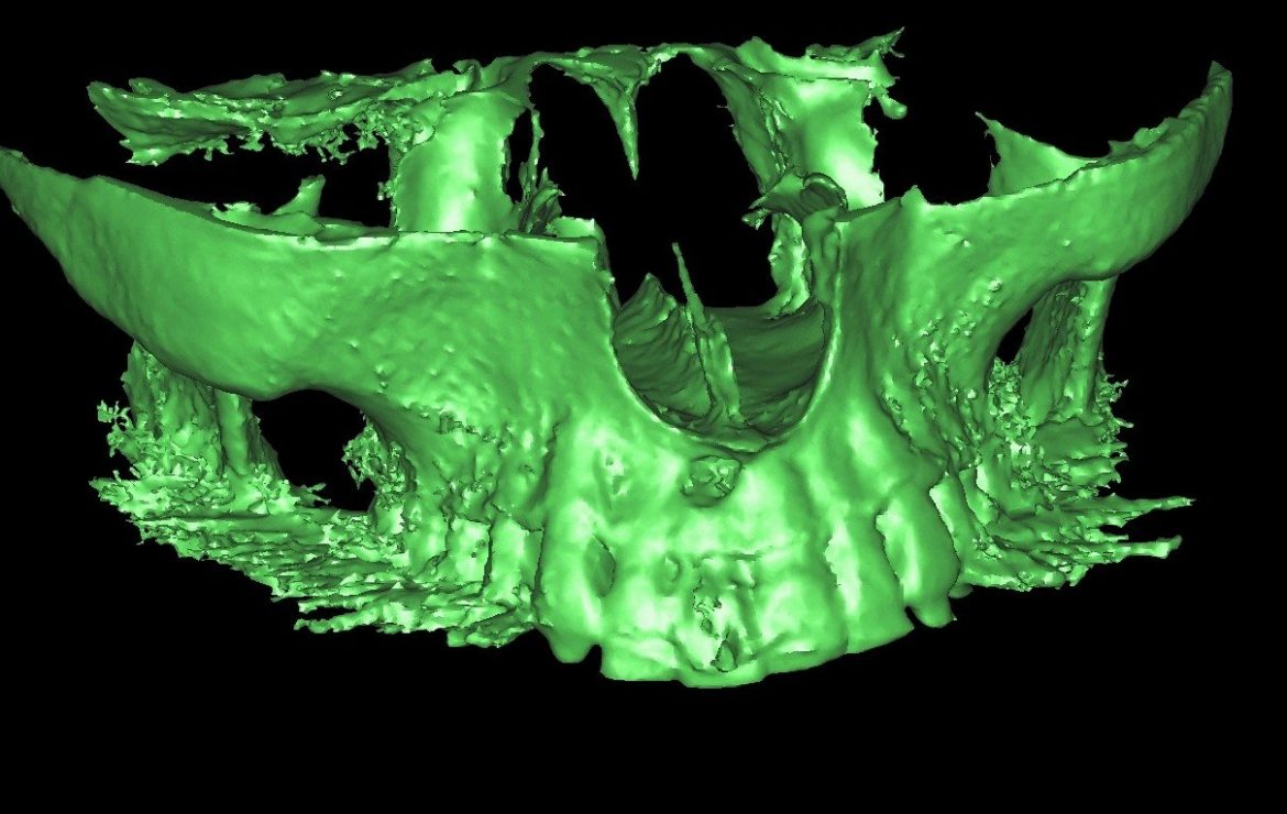 Root Canal Apicoectomy Failure – Relation to Dental Implants (Ramsey Amin DDS – Burbank, California)