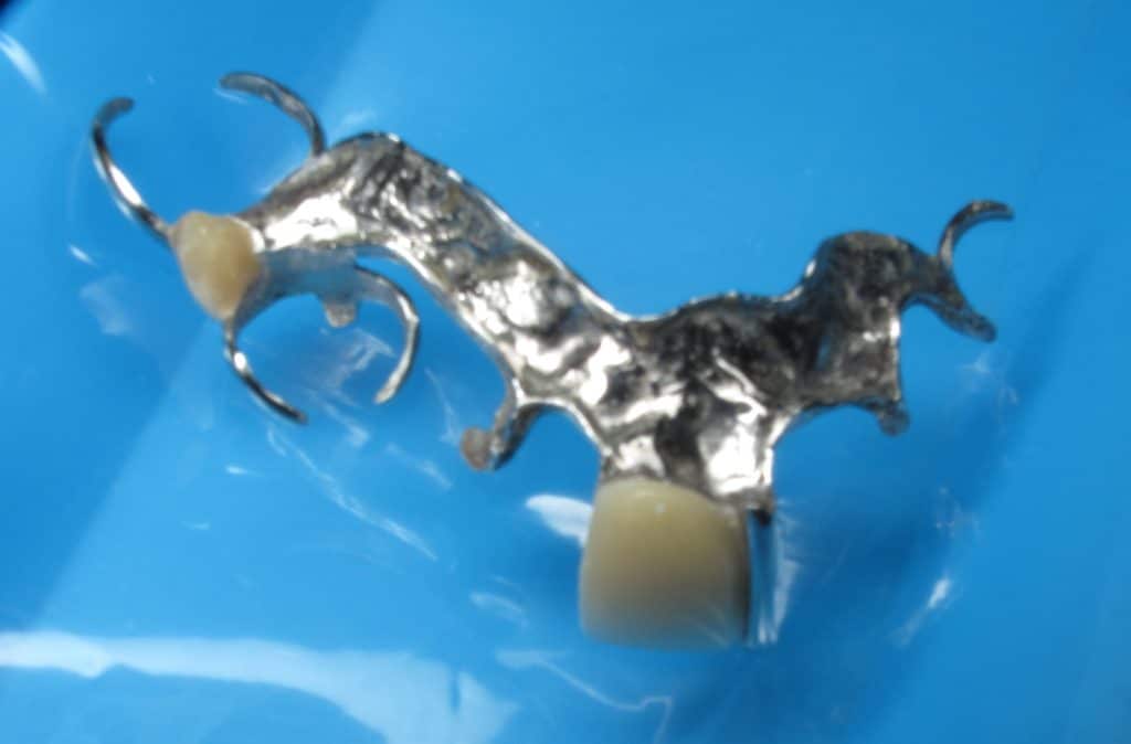 Partial removable denture