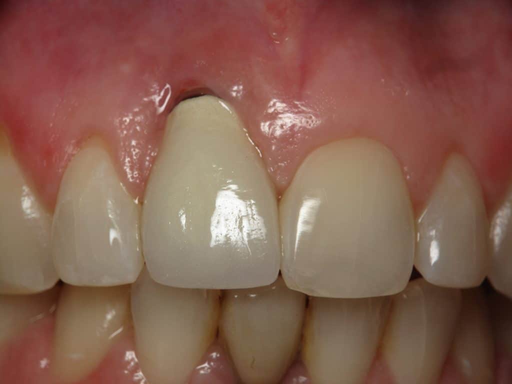 Center front dental implant with crown