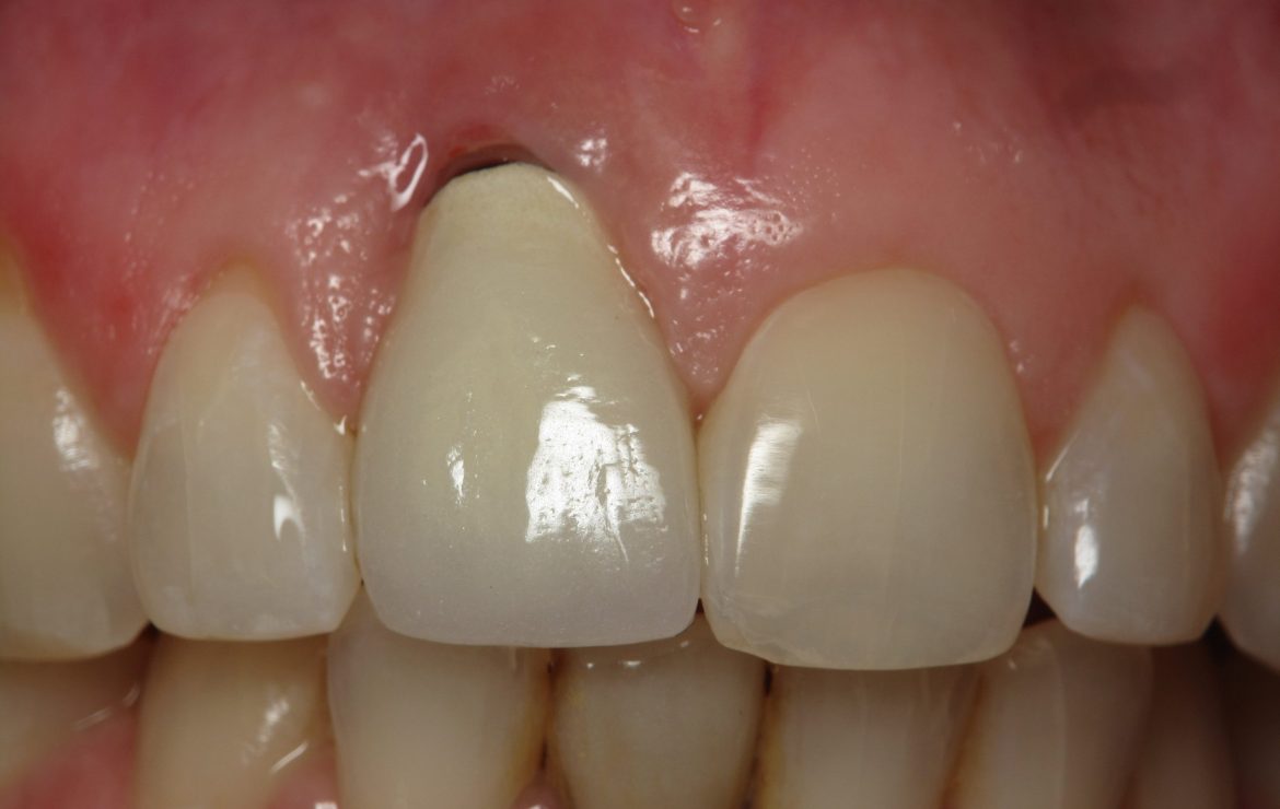 Burbank Dental Implant Dentist Discusses Best Angle of Surgical Dental Implant Placement