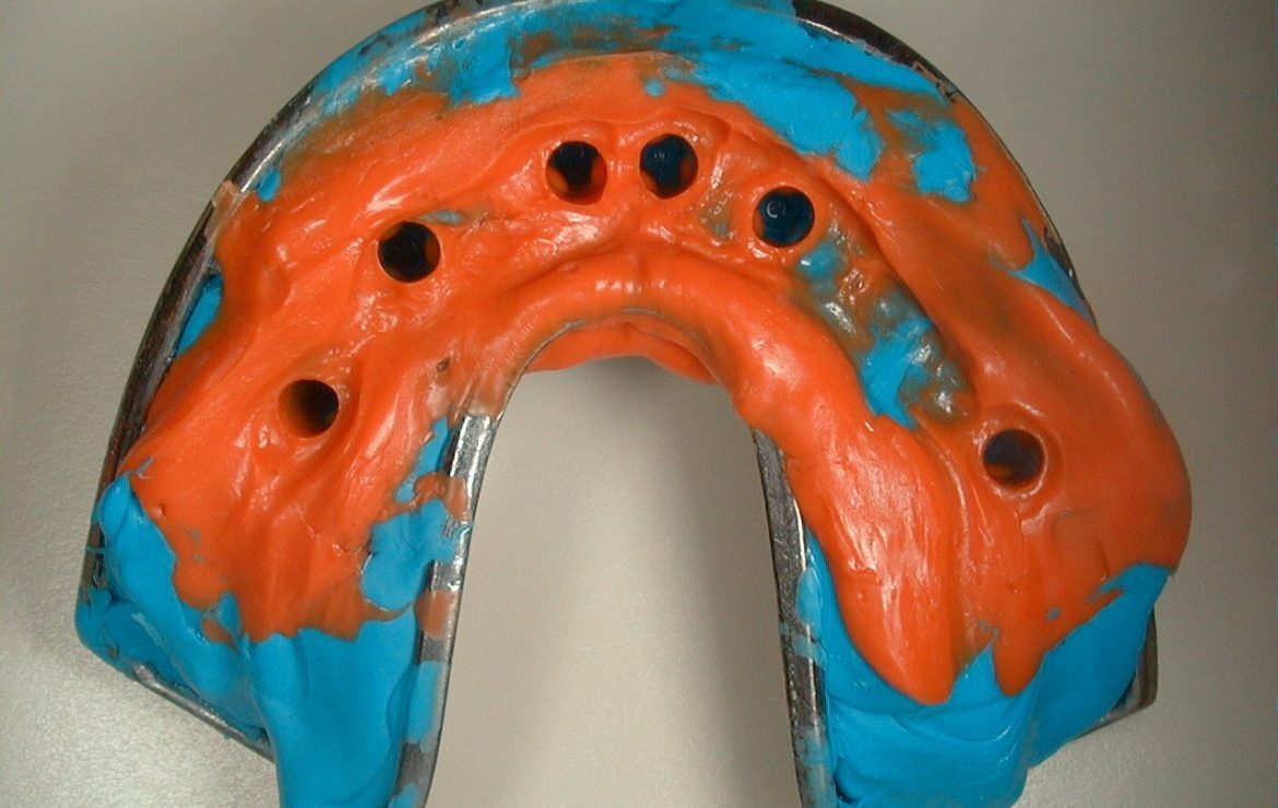 Burbank Expert Dentist Explains -Dental Implant Impression Molding Considerations