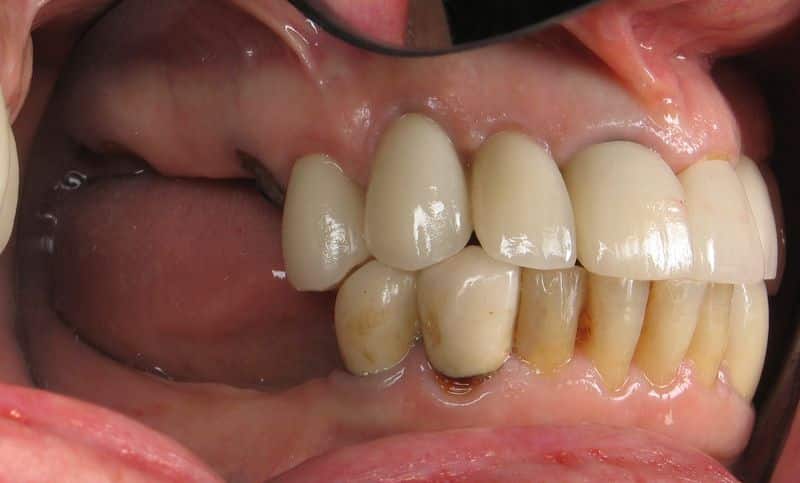 Missing upper and lower molars