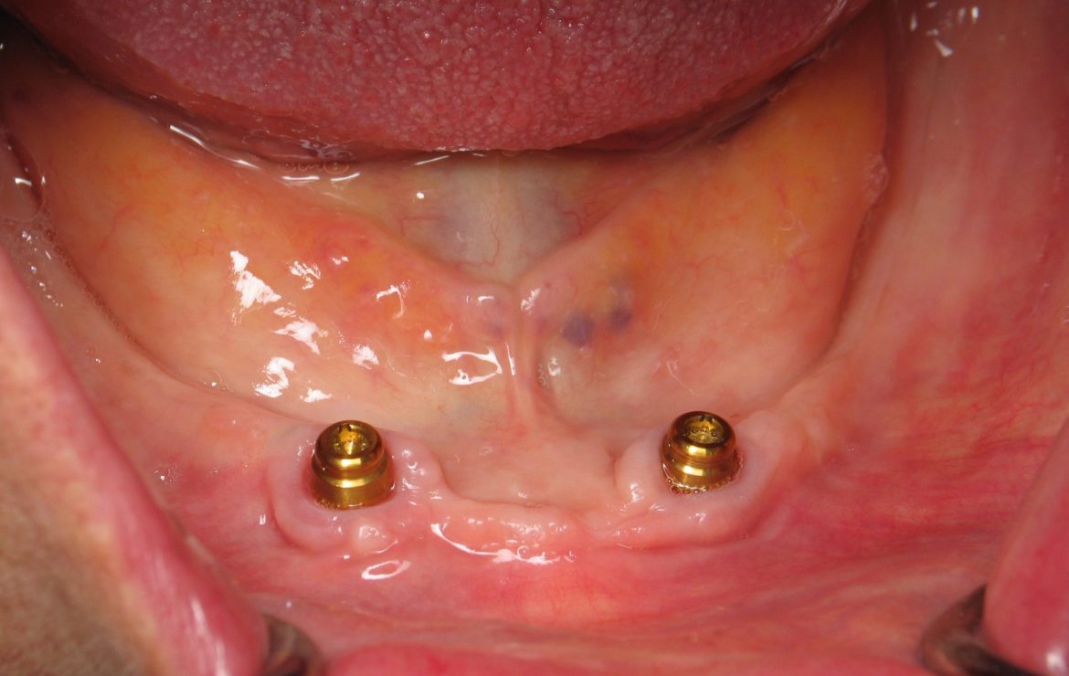 Snap In Dentures on Dental Implants – Burbank Dental Implant Specialist