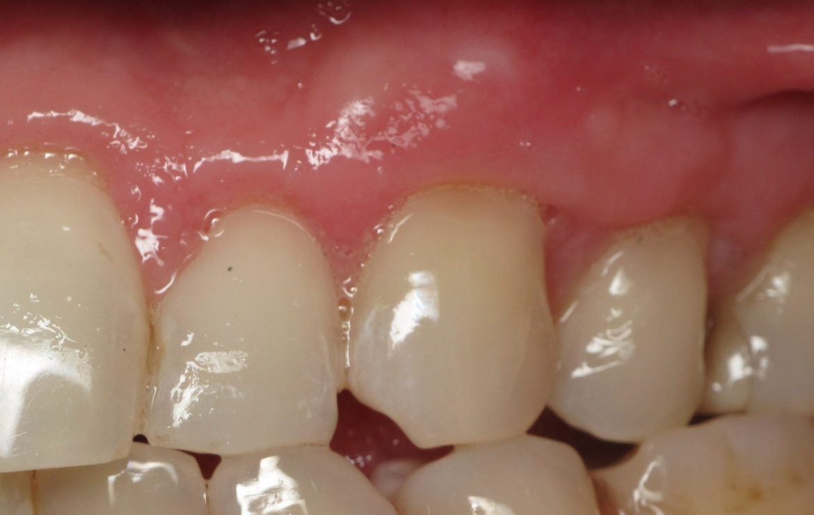 Thin Receding Gums And Dental Implants – What’s Important? Video by Ramsey Amin, DDS