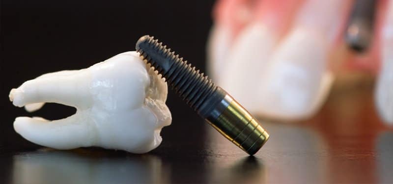 Dental implants: Mandibular neurovascular considerations 