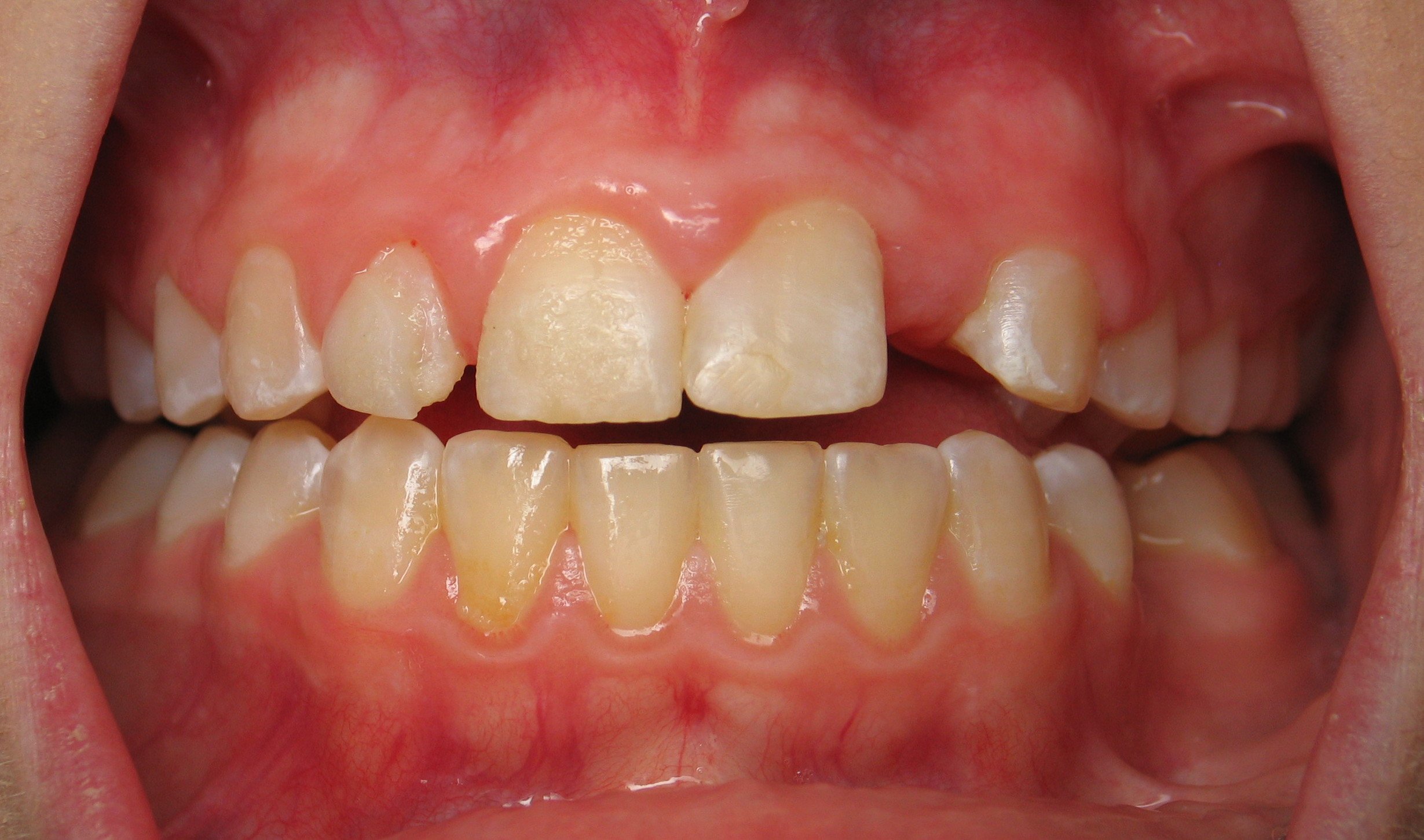 Invisalign First - Permanent & Baby Teeth