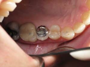 Burbank dental implant