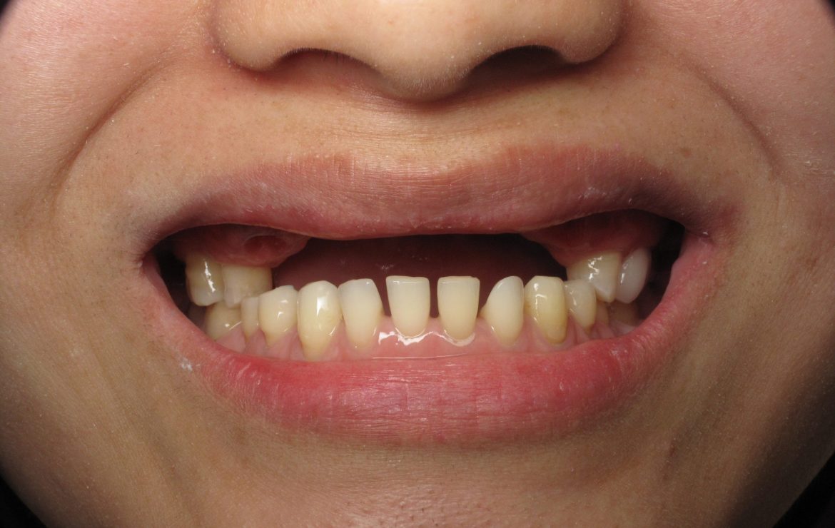 Alternatives To Bone Grafting For Dental Implant Teeth: A Unique Approach by L.A Dentist Ramsey Amin, DDS