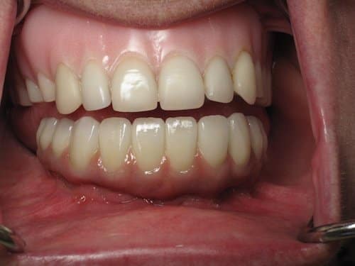 Should I Pull All of My Teeth and Get Dental Implants?