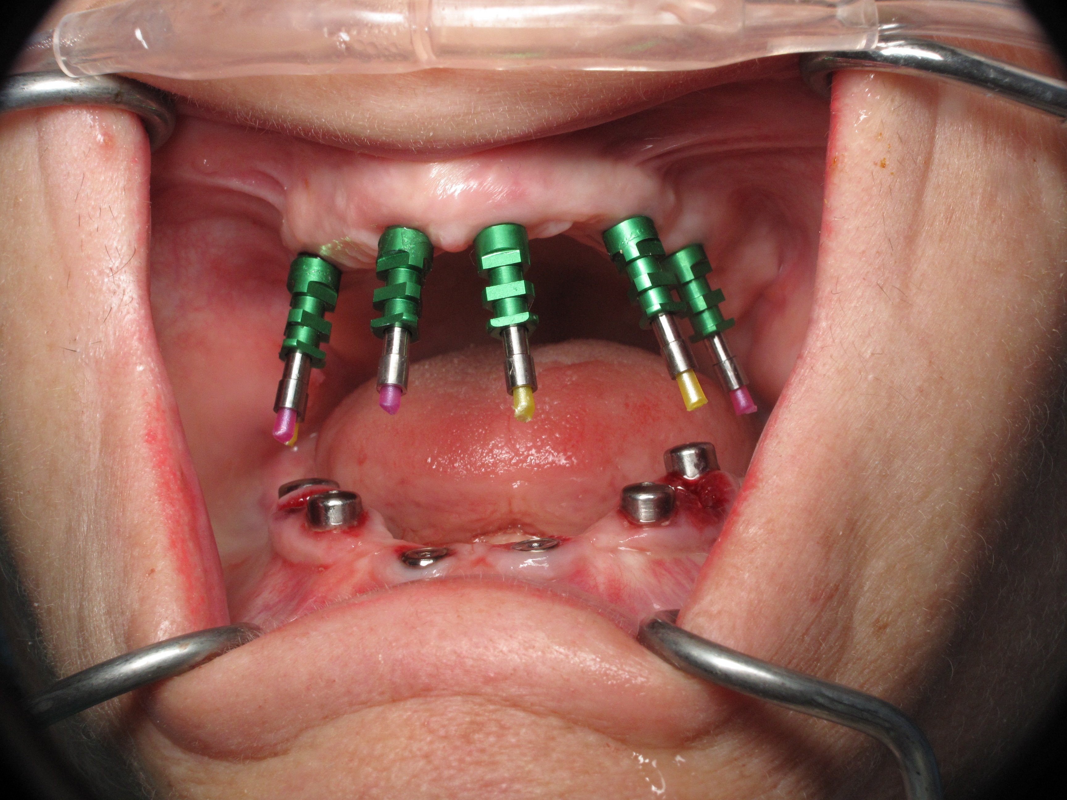 The Process Of Permanent Fixed Dental Implant Teeth 5 Steps To