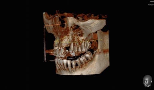 Bone is Showing After Tooth Extraction Graft