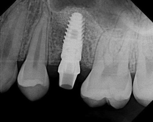 Dizzy_Vertigo After Sinus Lift Bone Graft for Dental Implant