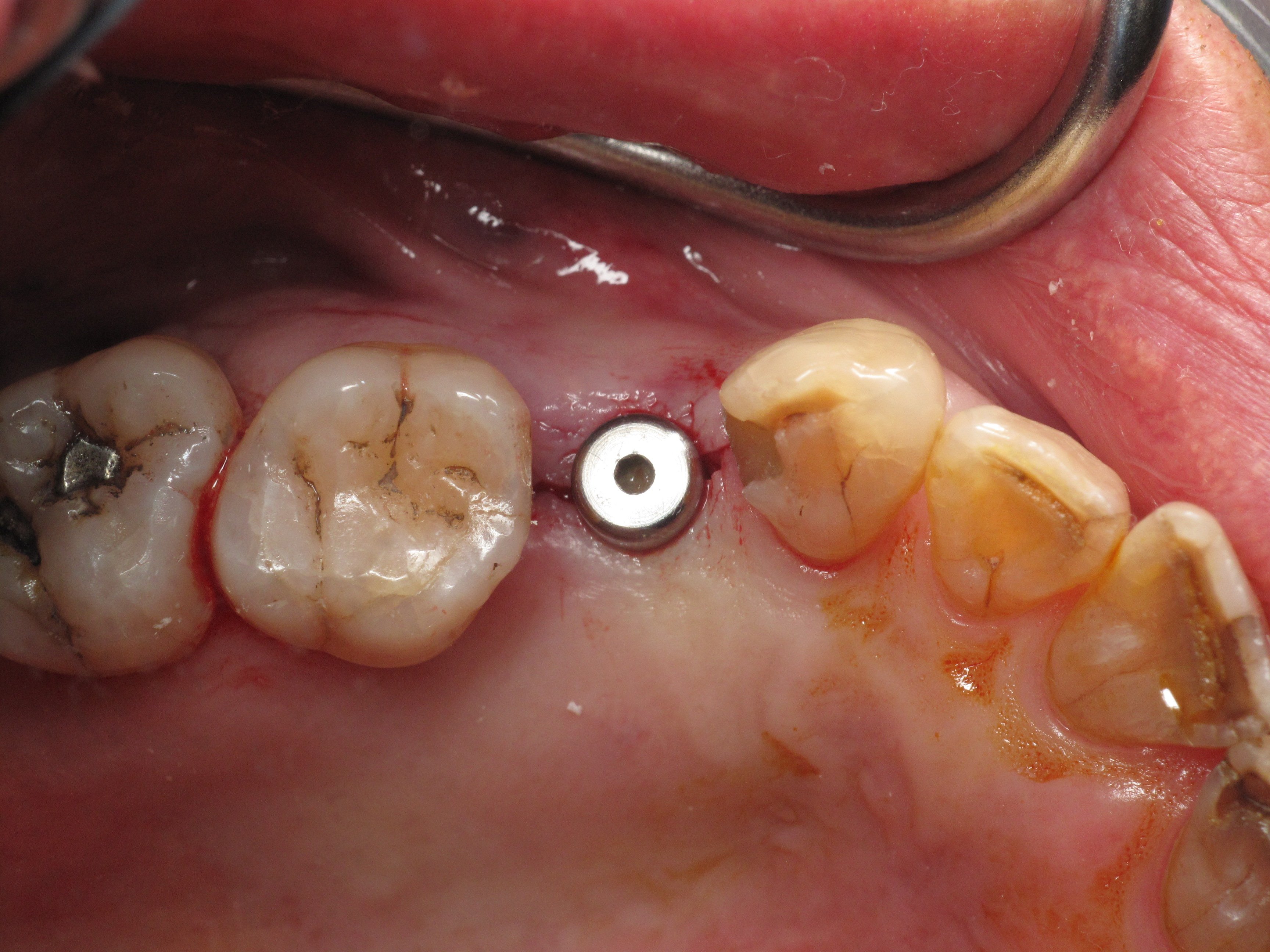 healing abutment in the mouth for dental implants