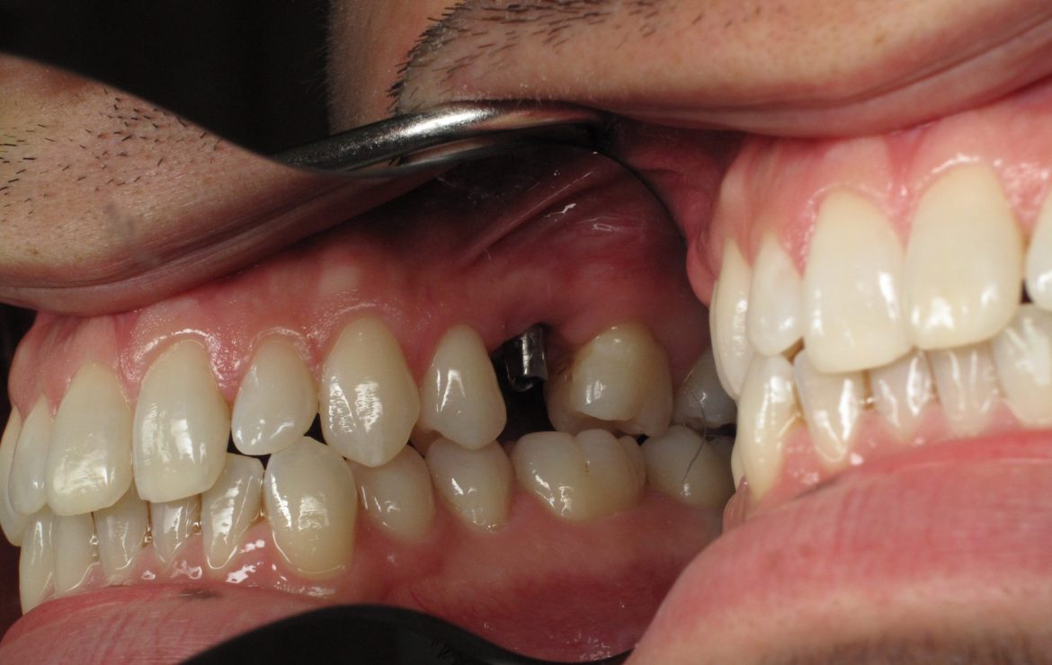 Wisdom Teeth Extraction/Coronectomy With Simultaneous Baby Tooth Dental Implant Replacement -Case Example