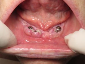 Diabetic that is not well managed is healing much slower