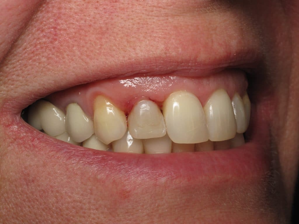 Shaping And Forming Gum Around Front Teeth Dental Implants