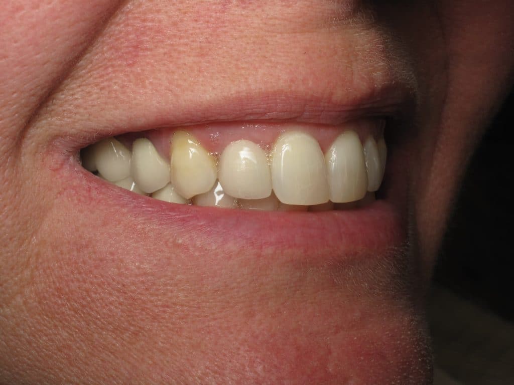 Shaping And Forming Gum Around Front Teeth Dental Implants