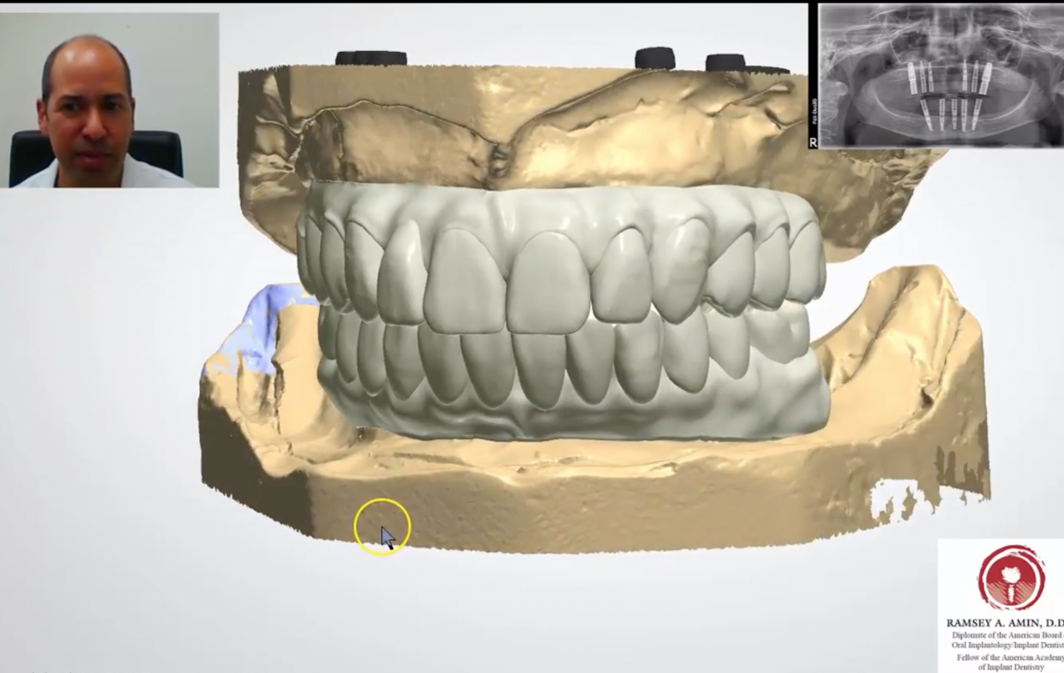 Full Arch All on 4, 5, 6, 7, 8 Implants – 3D Lab Teeth Design Video