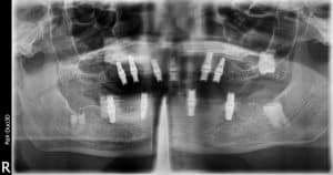 initial x-ray when I first met the patient--10 implants that would not work for over dentures