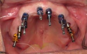 impression transfer on the upper 10 implants