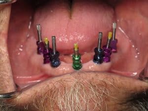 impression transfer on the lower 7 implants
