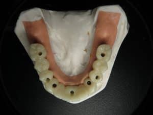 screw retained full arch temporary dental implant bridge