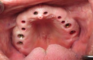 narrow gum the sulcus channelson the existing implants towards the front of the mouth