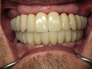 fully biting into full mouth fixed temporary implant Fp1 teeth