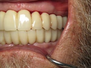 PMMA double arch full mouth dental implant fixed temporaries--other side