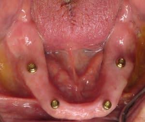 pre-existing condition when I met the patient-lower jaw