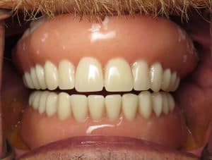 bulky, huge dental implant over dentures...poorly done