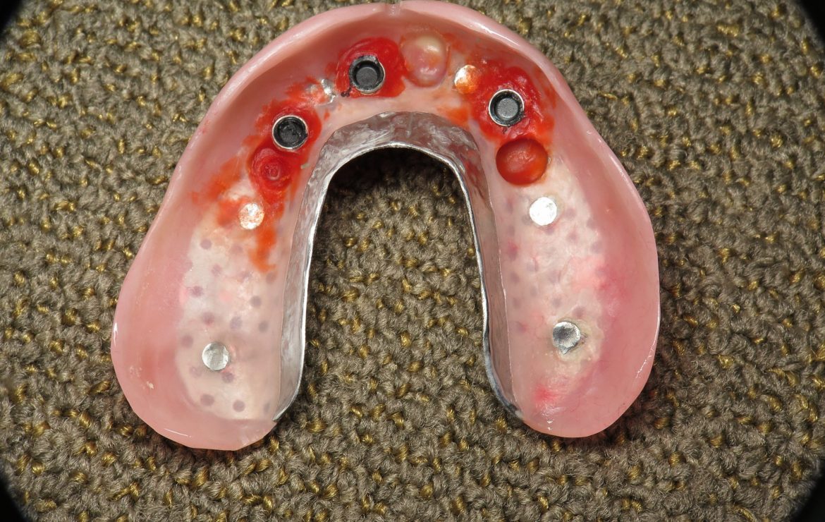 Dental Implant “Overdenture” Basics – Dr. Ramsey Amin, Burbank, CA