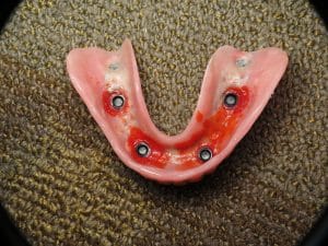 poorly made overdenture attachment connection
