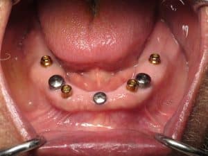 after healing on the lower arch dental implants