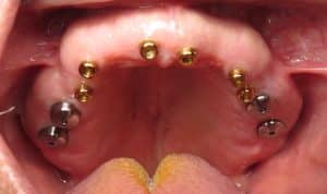 after healing on the upper arch dental implants