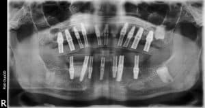 x-ray of the 17 implants during the process. Some of the implants were placed by me in some by previous dentist.