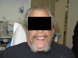 Handsome smile with temporary upper and lower full arch teeth.