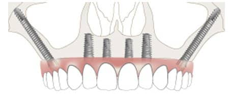 Zygomatic implants