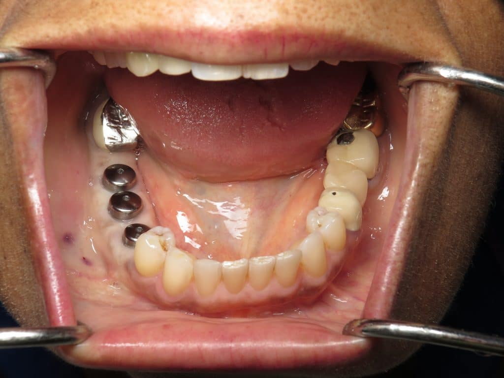 dental implant healing abutments -Mouth