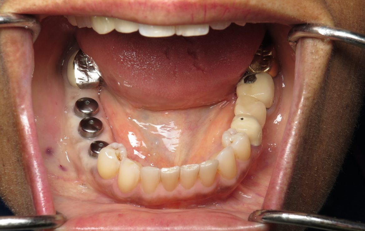 Replace Loose Long Bridge -Dental Implants And Bone Expansion