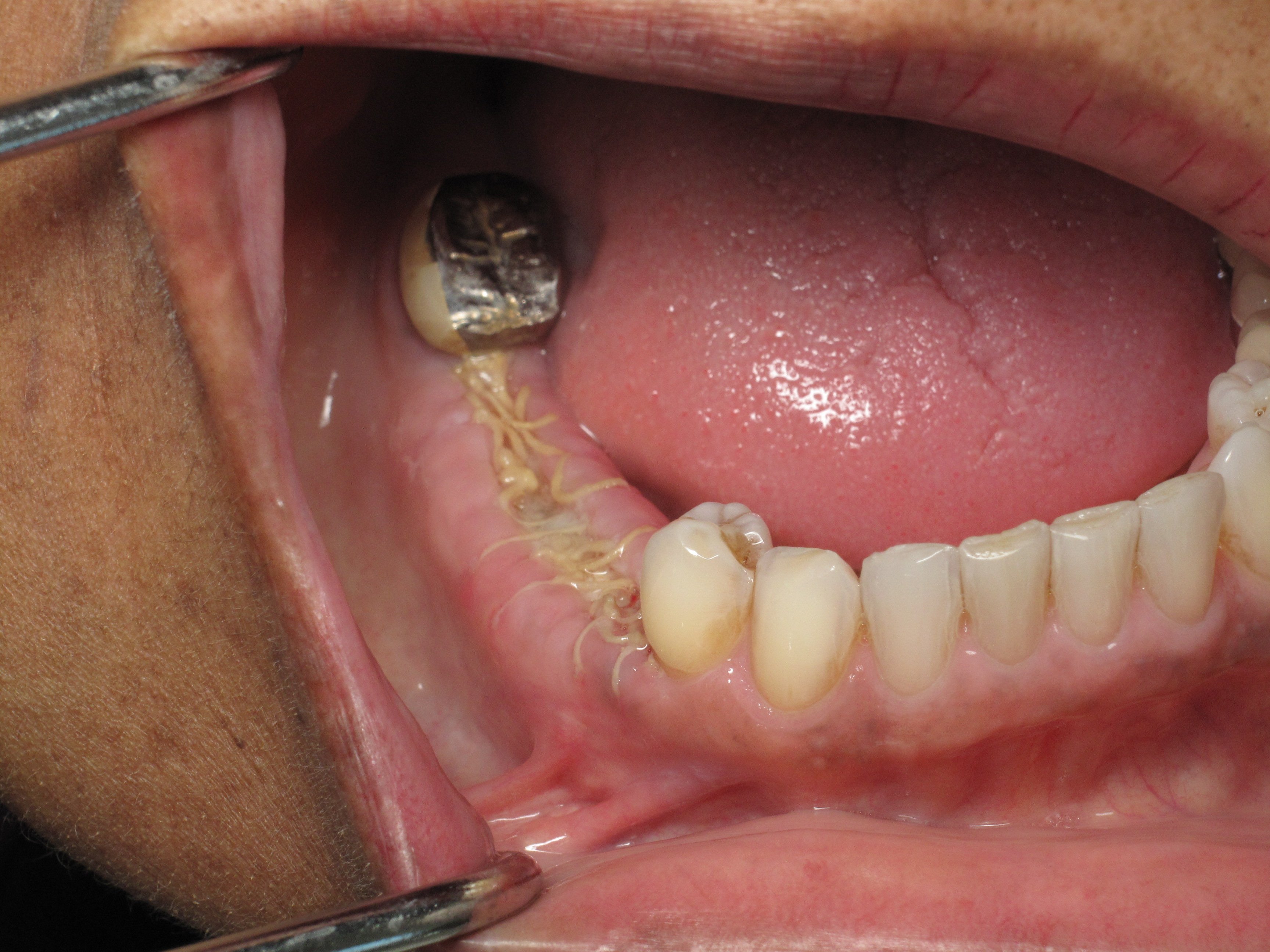 Replace Loose Long Bridge -Dental Implants And Bone Expansion