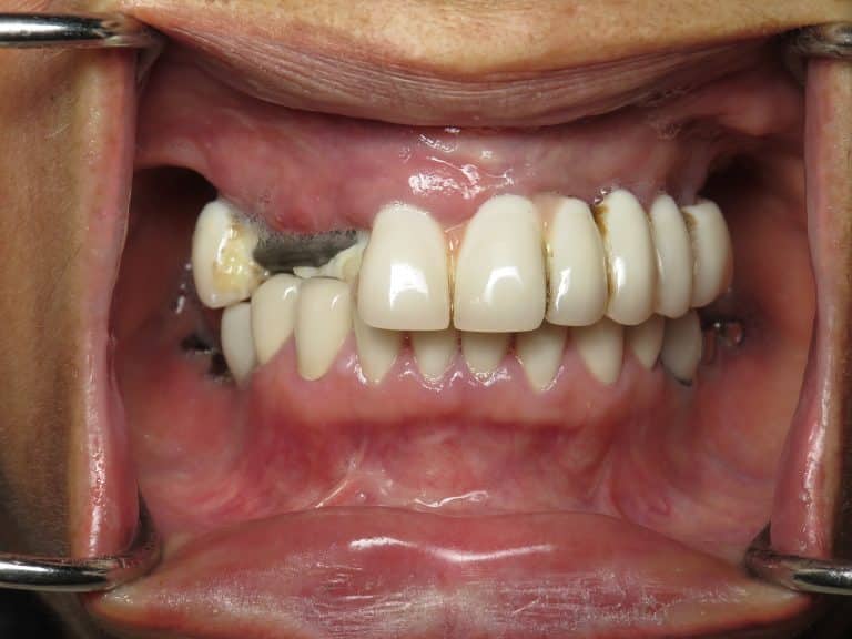 Broken All On 4 Dental Implant Bridges