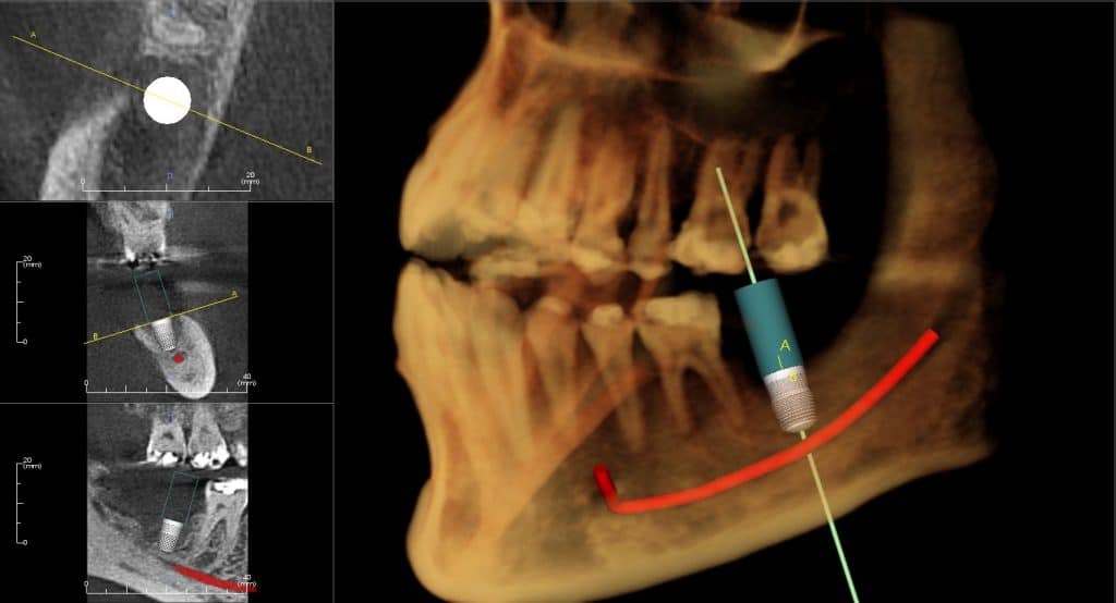 SameDay Extraction Immediate Lower Molar Dental Implants And Nerve