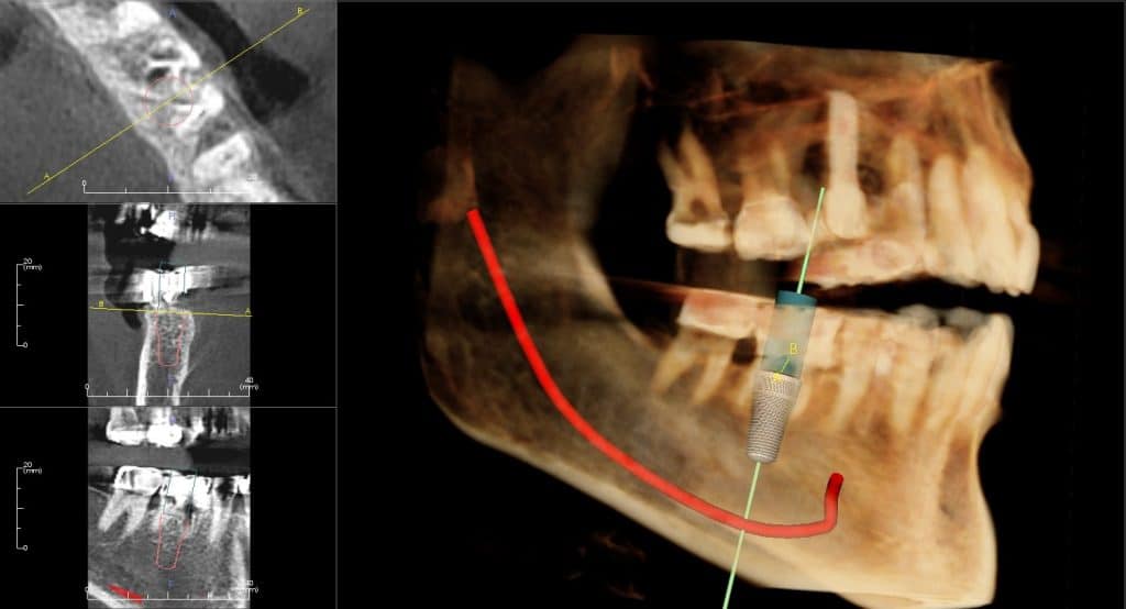 SameDay Extraction Immediate Lower Molar Dental Implants And Nerve