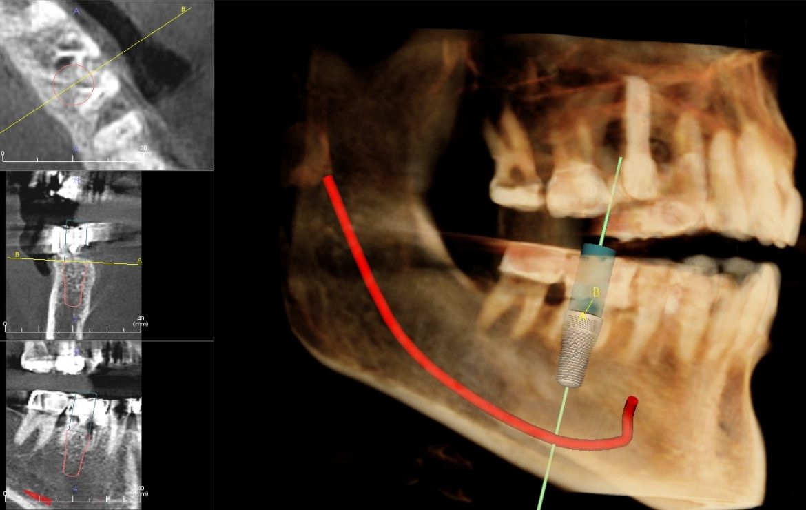 Same-Day Extraction Immediate Lower Molar Dental Implants And Nerve Injury Discussion