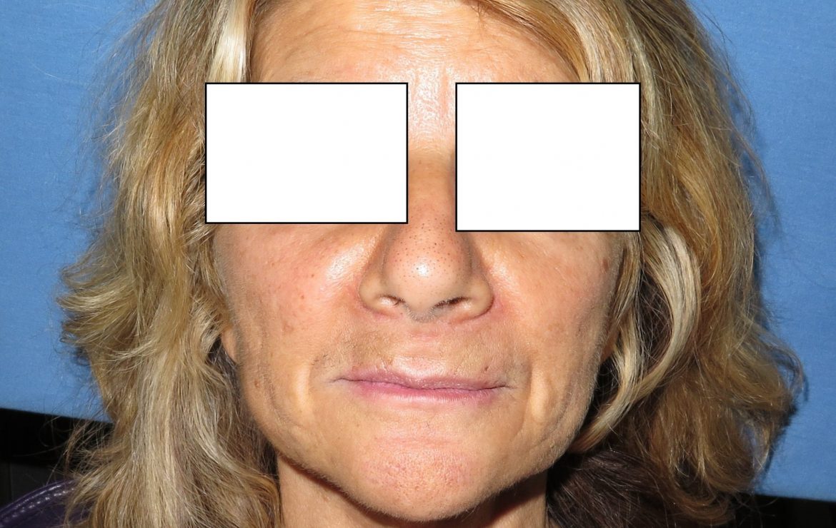 All on 4/6 Prettau Fixed Implant Bridge Lip and Facial Support Considerations
