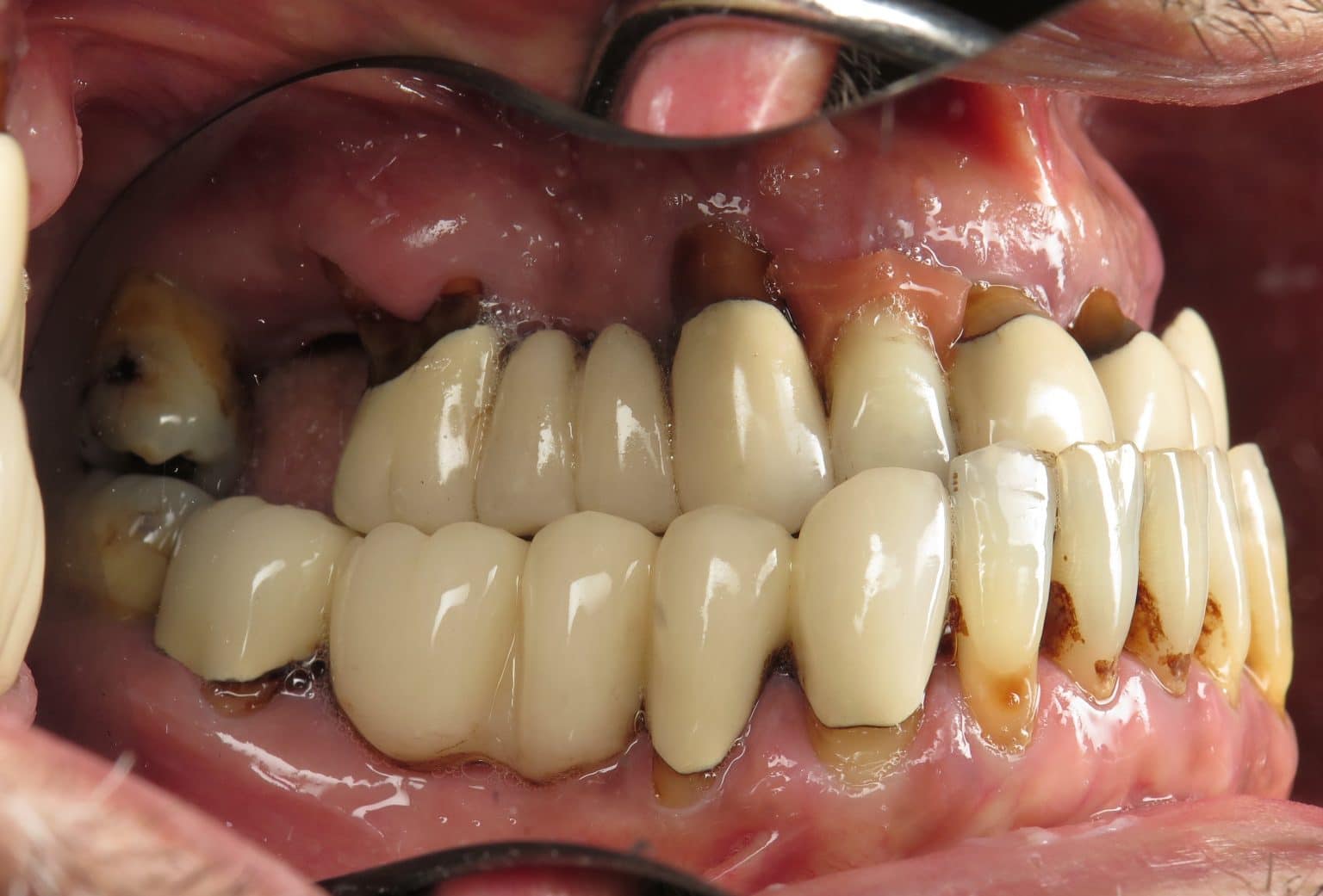 Temporary Full Implant Teeth. Why Do This Step?